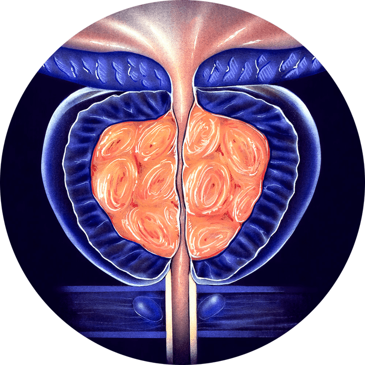 Prostatitis kronikoa