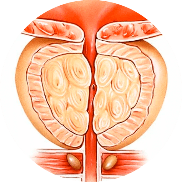 Tratatu gabeko prostatitisaren ondorioak