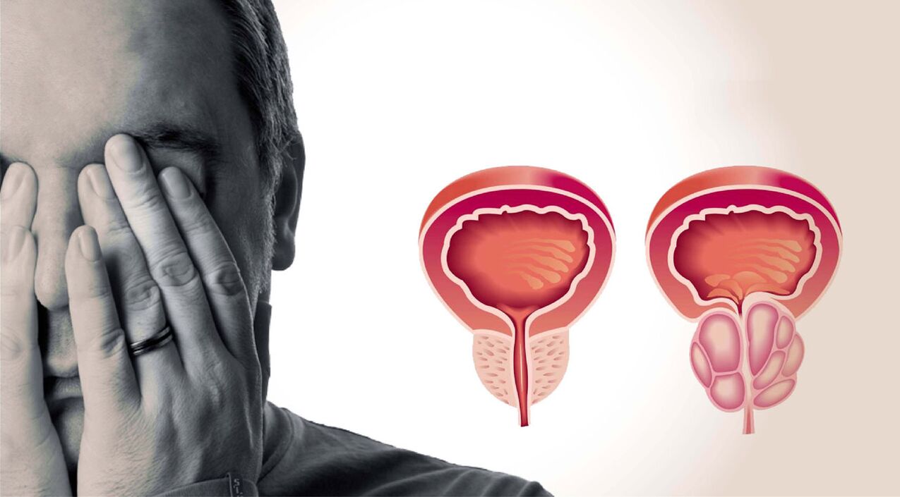 prostatitis kronikoa gizonezkoetan