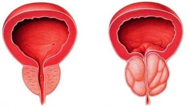 osasuntsu eta hanturatutako prostata prostatitisarekin
